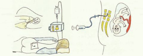 Analgesia epidural